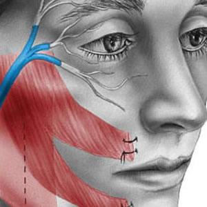 Rehabilitación por Parálisis Facial