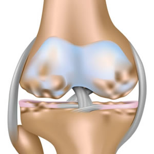 Rehabilitación por Osteoartritis