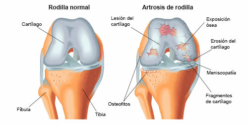 Rehabilitación por Osteoartritis